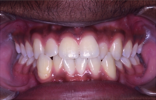 Patient A. A smile before orthodontic treatment at Wire Orthodontics (photo 1)