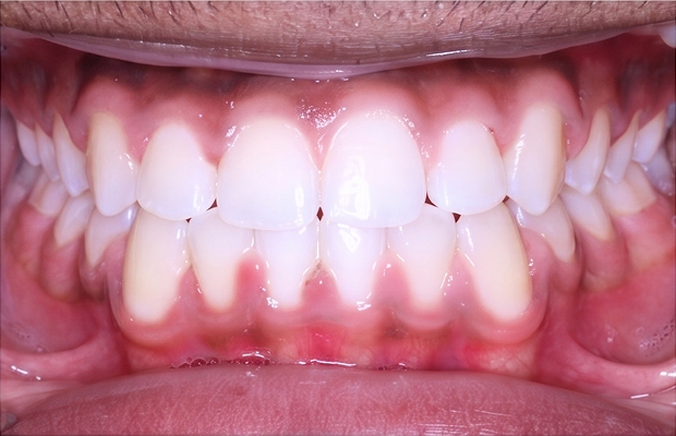 Patient A. A smile after orthodontic treatment at Wire Orthodontics (photo 1)